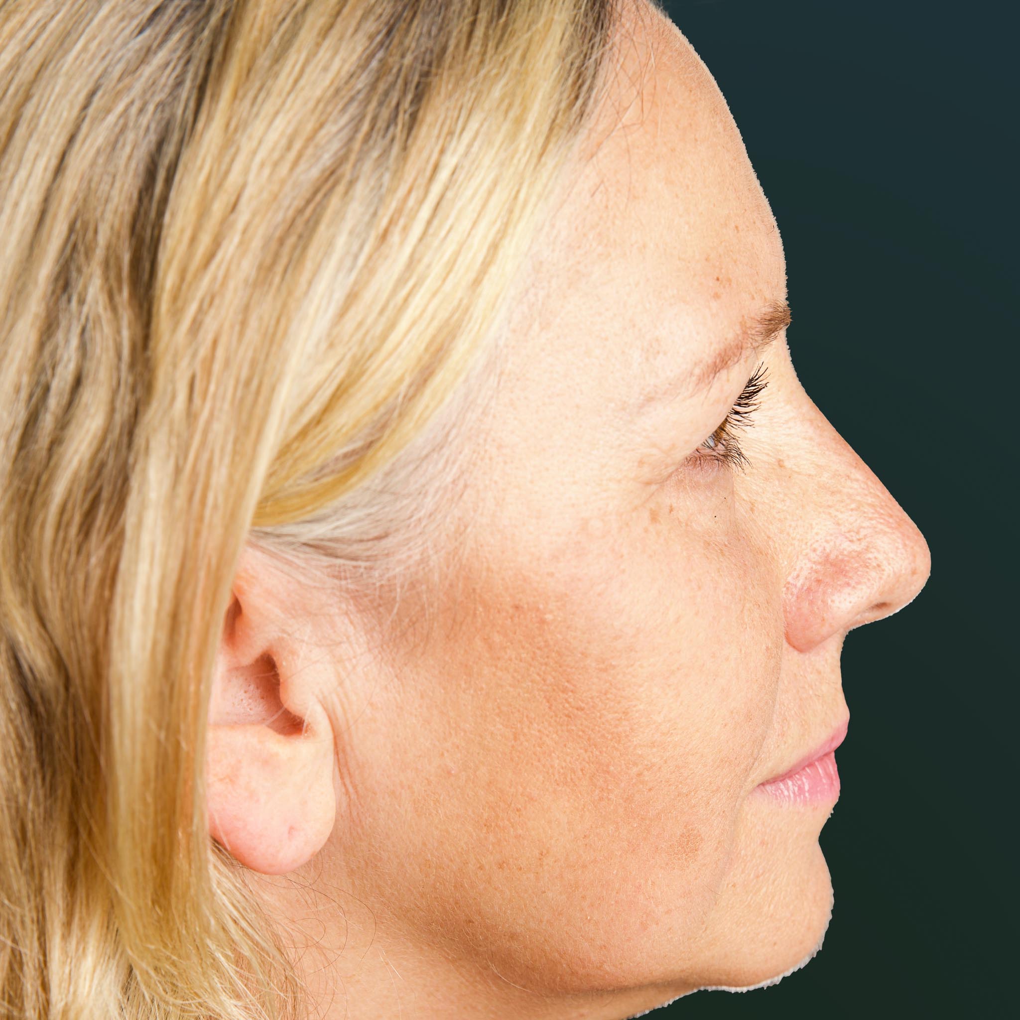 Rhinoplastik